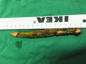 插入男子腦內(nèi)的樹枝。